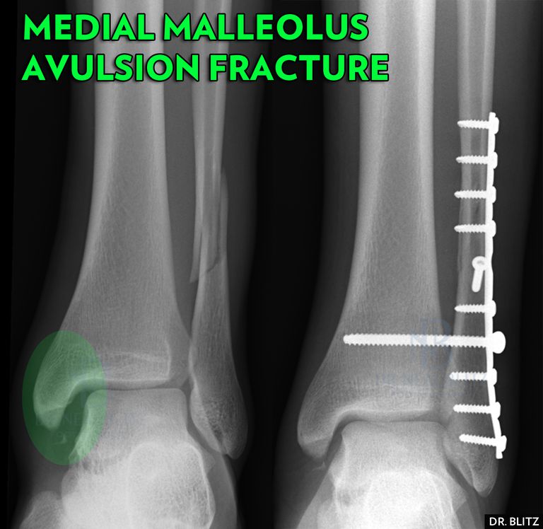 malleolaire fracturen, mediale malleolaire, fracturen mediale, fracturen mediale Malleolus, mediale malleolus
