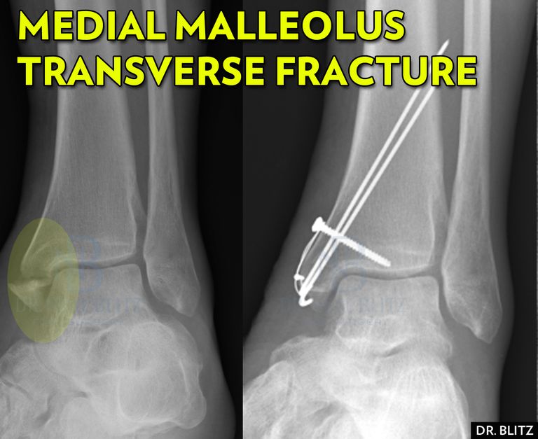 malleolaire fracturen, mediale malleolaire, fracturen mediale, fracturen mediale Malleolus, mediale malleolus