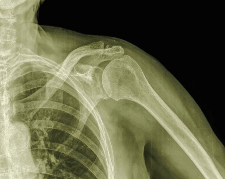 glenohumerale artritis, botten sleutelbeen, genoemd gewricht, kruising drie, sleutelbeen schouderblad, sleutelbeen sleutelbeen