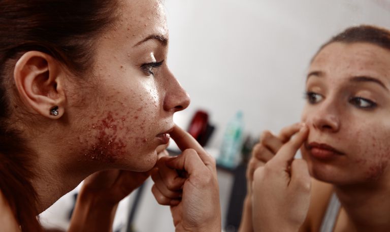 acne niet, Acne vulgaris, acne worden, behandeling acne, deze leeftijd, geval acne