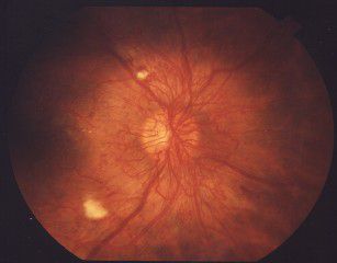 diabetische retinopathie, worden gebruikt, bloedvaten kunnen, bloedvaten verminderen