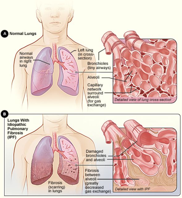 deze ziekte, mensen ziekte, pulmonaire fibrose, Verenigde Staten