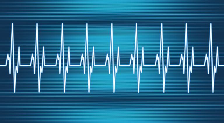 elektrische verbinding, mensen AVRT, elektrische verbinding tussen, kamers hart, tachycardie AVRT