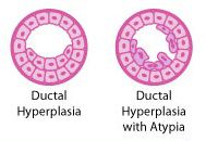ductale hyperplasie, atypische ductale hyperplasie, atypische ductale, atypische hyperplasie, cellen zijn