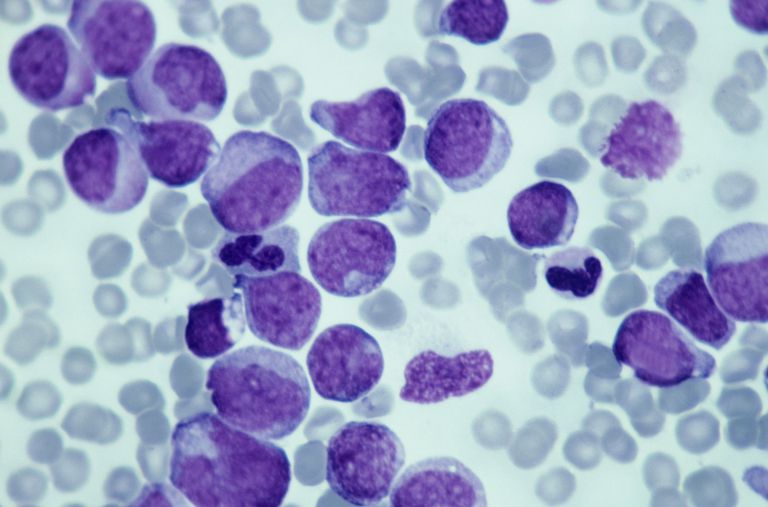 witte bloedcellen, bloedcellen witte, bloedcellen witte bloedcellen, macroglobulinemie Waldenstrom, medische behandeling