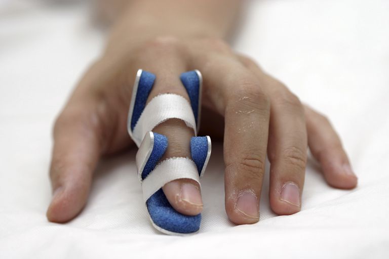 gebroken vinger, gewonde vinger, worden gecorrigeerd, belangrijke factoren, breuk stabiel, breuk stabiel onstabiel