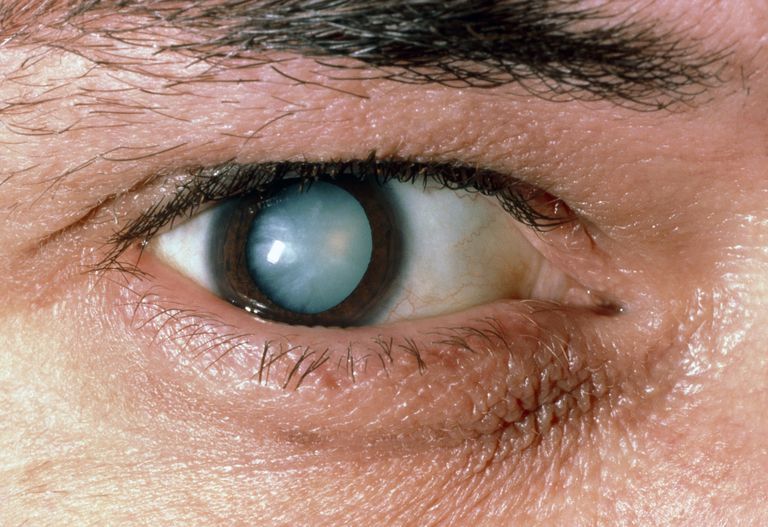 cataract heeft, cataract vormt, cataract vormt zich, deel lens, kunnen worden, meestal niet