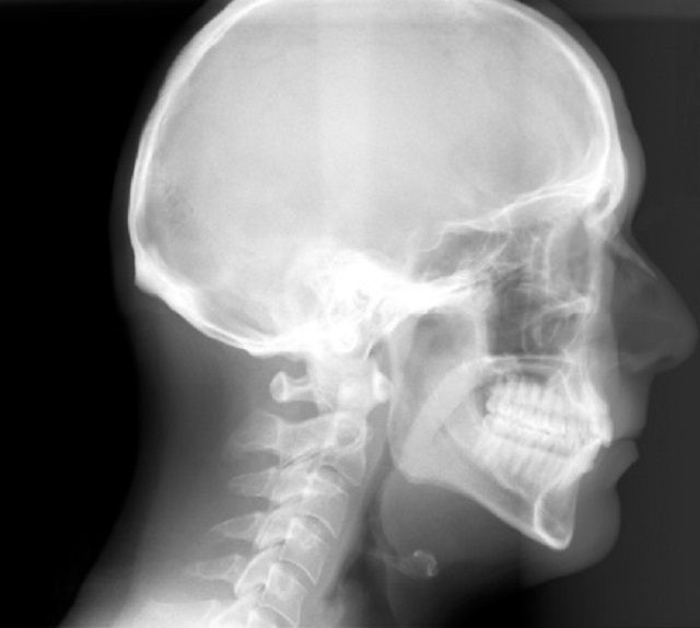 cephalometrische röntgenfoto, röntgenfoto wordt, orthodontische behandeling, worden gebruikt, cephalometrische röntgenfoto wordt