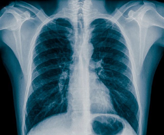 röntgenfoto borst, blootstelling straling, andere aandoeningen, borst zijn