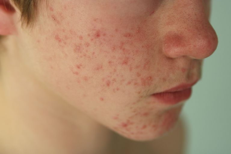 acne veroorzaakt, acne zijn, medische term, meeste mensen
