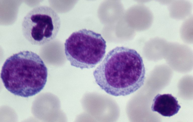 type leukemie, chronische leukemie, witte bloedcellen, leukemie komen, meest voorkomende, vormen leukemie