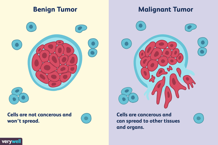 tumoren kunnen, goedaardige tumor, Kwaadaardige tumoren kunnen, delen lichaam, goedaardige tumoren, Kwaadaardige tumoren