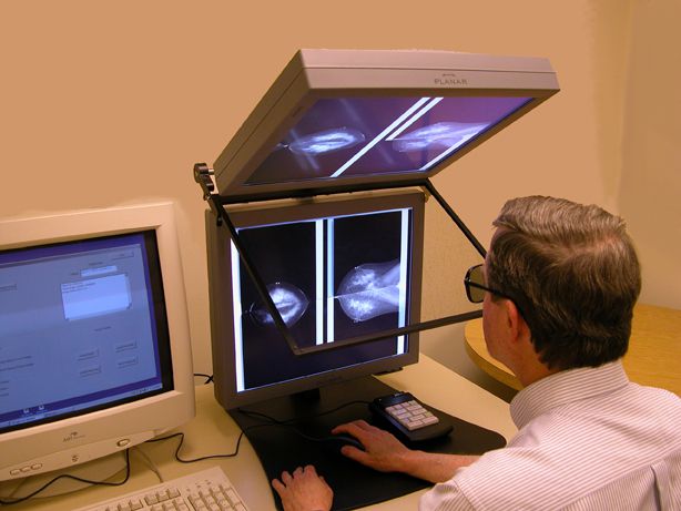 digitale mammografie, Digital Mammographic, Digital Mammographic Imaging, Imaging Screening, Imaging Screening Trial, Mammographic Imaging