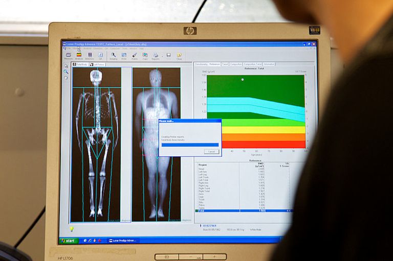 jaar ouder, DEXA Scan, dual-energy x-ray, dual-energy x-ray absorptiometry, voor osteoporose