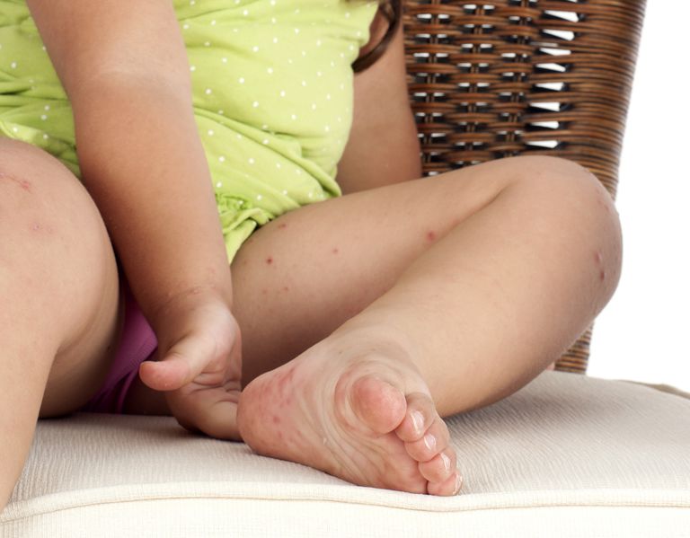 allergische reactie, kind veroorzaakt, netelroos kind, netelroos veroorzaakt, netelroos behandelen