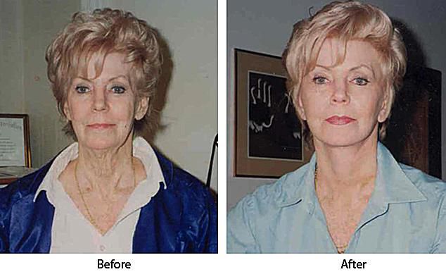 bovenste onderste, Deze vrouw, endoscopische wenkbrauwlift, facelift endoscopische, plastische chirurgie