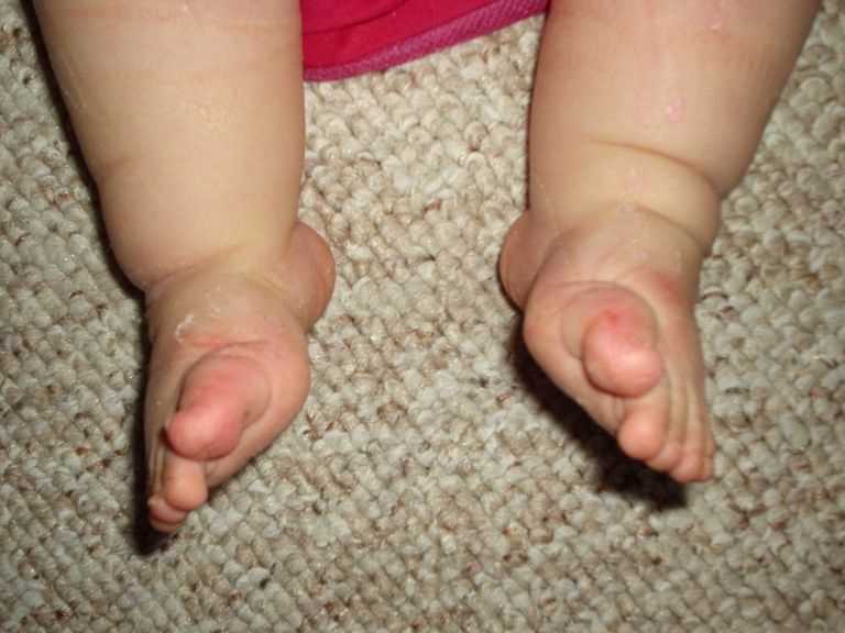 verticale talus, baby worden, beide voeten, ervoor zorgen