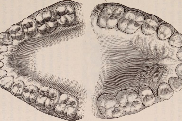 extra tanden, behouden kauwen, behouden kauwen malen, door tandarts, gebruikt voor