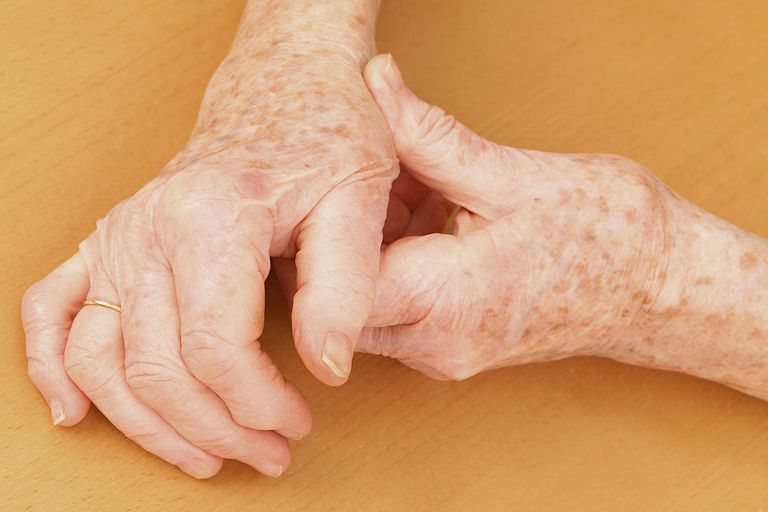 basis duim, middelste gewricht, osteoartritis hand, worden knooppunten