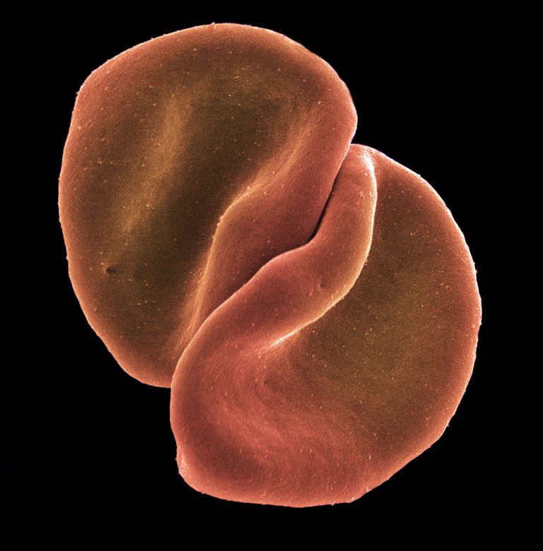 rode bloedcellen, drie maanden, Afrikaanse mediterrane, Afrikaanse mediterrane Zuidoost-Aziatische