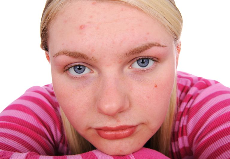mensen acne, nodig hebt, acne niet, ervoor zorgen