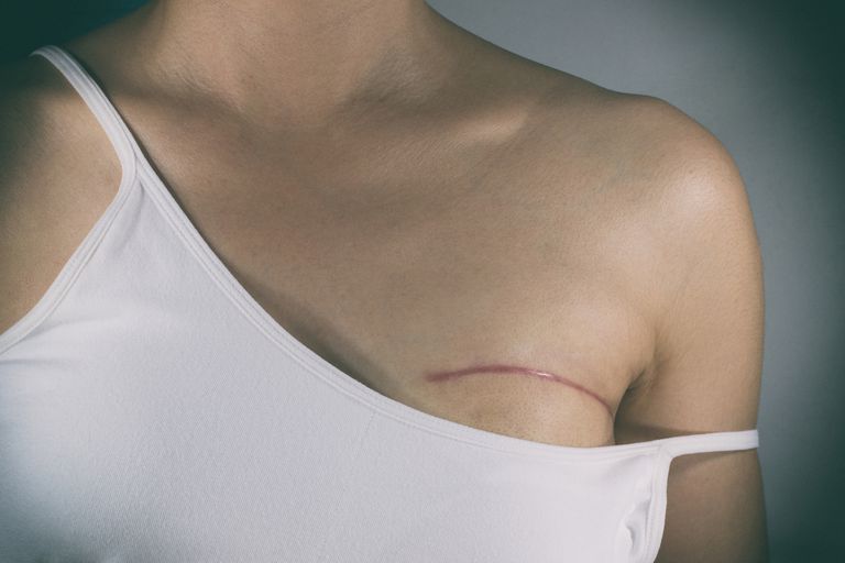 reconstructieve chirurgie, niet alleen, sommige vrouwen, Zorg ervoor, beide borsten