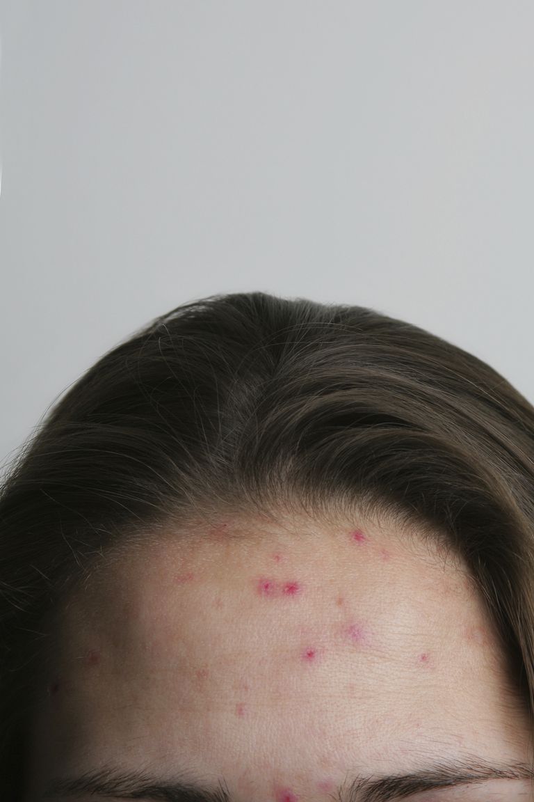 acne Hormonen, acne vaak, acne veroorzaken, betekent niet