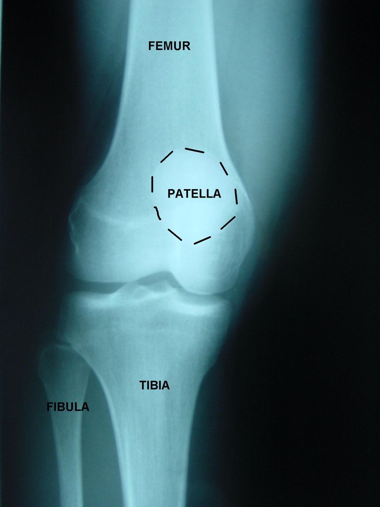 bevindt zich, invasieve chirurgische, knie enkel, knieschijf patella, meest voorkomende, noemen segment