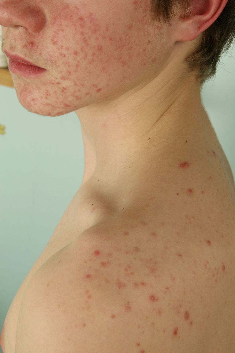 inflammatoire acne, ernstigere vormen, kunt ernstigere, kunt ernstigere vormen, ontstekingsacne krijgen, rode puistjes