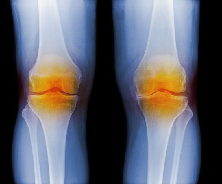 Reumatoïde artritis, betrokken zijn, door proteïnasen, gekenmerkt door