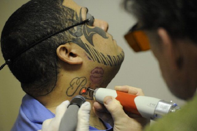 verwijderen laser-tatoeages, tatoeage verwijderen, voor verwijderen, worden verwijderd
