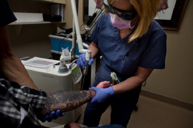 verwijderen laser-tatoeages, tatoeage verwijderen, voor verwijderen, worden verwijderd