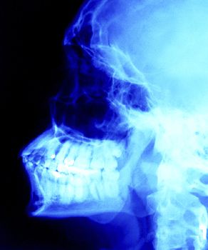 tandheelkundige röntgenfoto, risico schildklierkanker, röntgenfoto tanden, verhoogd risico