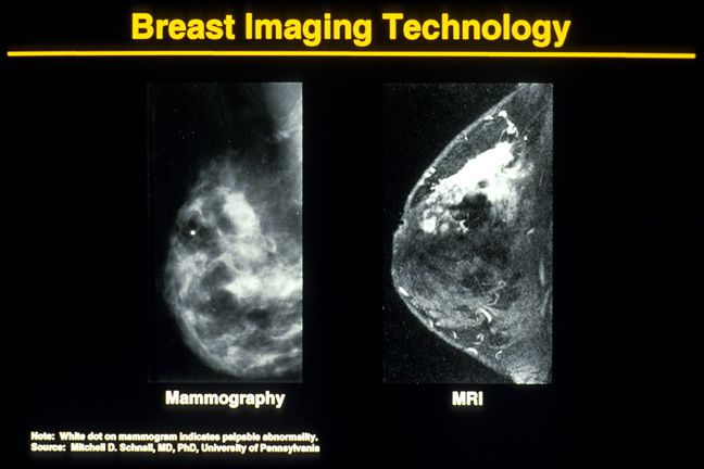 dicht borstweefsel, echografie borst, gebieden zijn, kanalen lobben