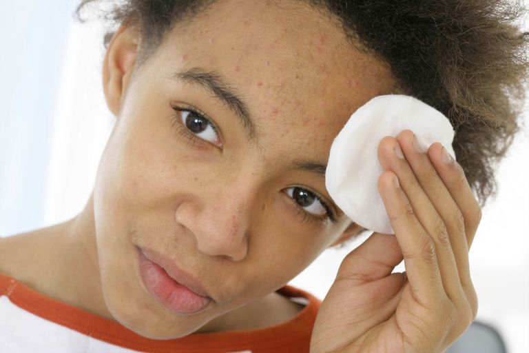 milde acne, voor behandeling, behandeling acne, kunnen helpen