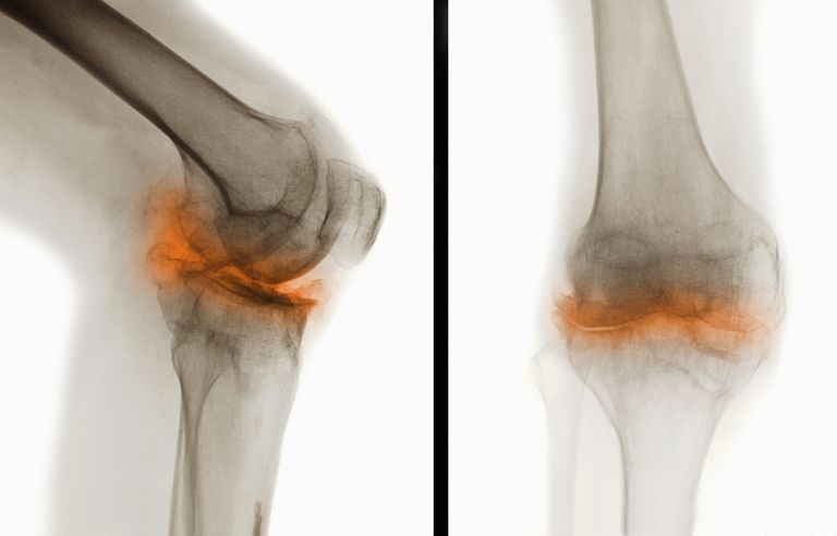 moet weten, Reumatoïde artritis, veroorzaakt door, meest voorkomende, voorkomende vorm, artritis Artrose