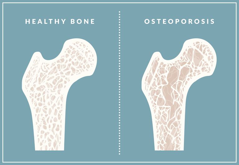 andere behandelingsopties, behandeling osteoporose, Fosamax arts, hebben ontwikkeld, klasse geneesmiddelen, Meer informatie