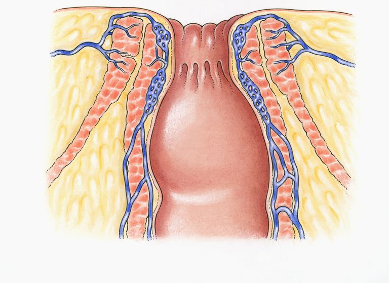 anale sluitspier, ziekte Crohn, anale sfincter, externe spier, inflammatoire darmaandoeningen, rond anus