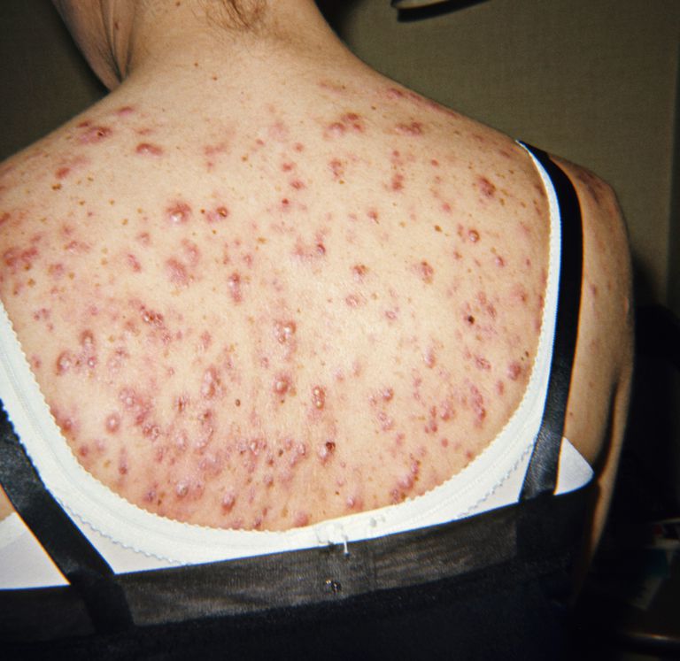 nodulocystische acne, Nodulocystic acne, acne nodulaire, acne worden, behandeld door, behandeld door dermatoloog