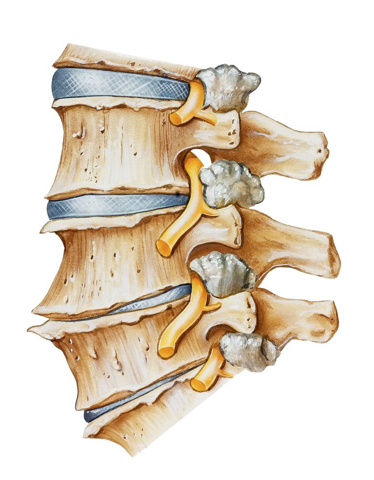 spinale artritis, aandoening bekend, cervicale radiculopathie, facetgewrichten onder, facetgewrichten onder hoek