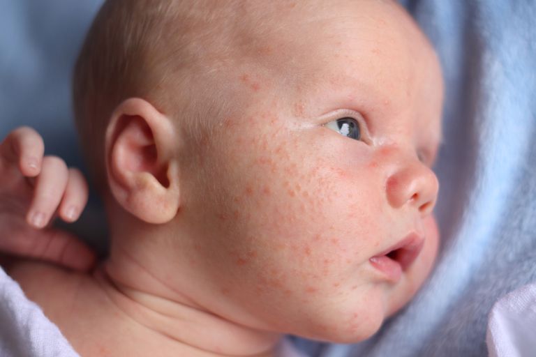 infantiele acne, acne baby, acne hebben, baby infantiele, baby infantiele acne