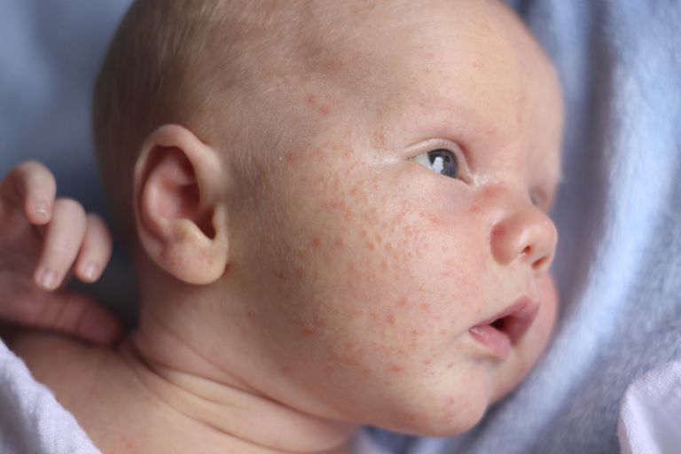 acne heeft, geen zorgen, gezicht baby, pasgeboren baby