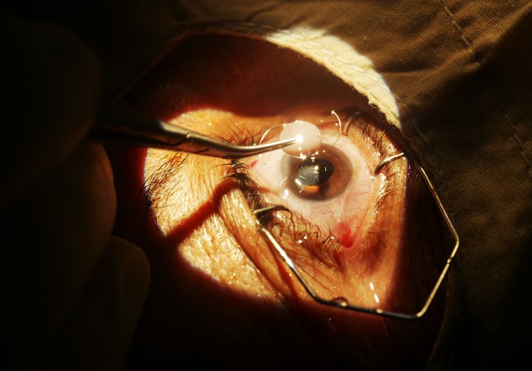 cataractchirurgie wordt, cataractchirurgie wordt uitgevoerd, gedurende weken, kleine fragmenten, kleine incisie