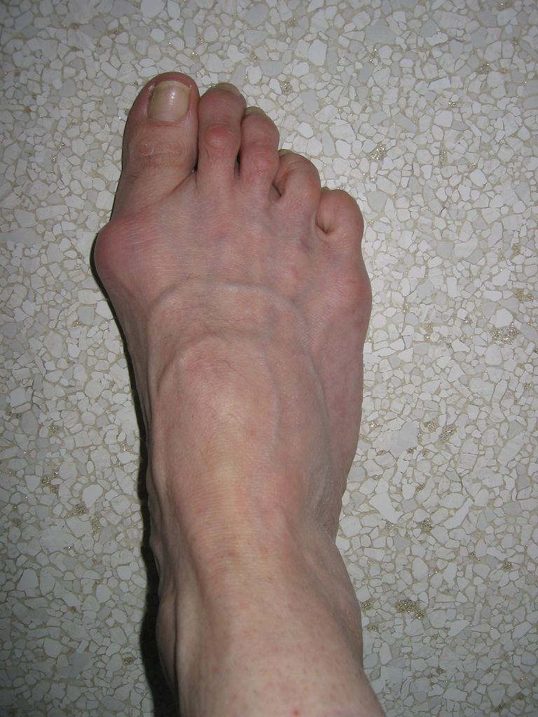 grote teen, ernst bunion, kunnen bijdragen, onder eerste, strakke schoenen, tweede teen