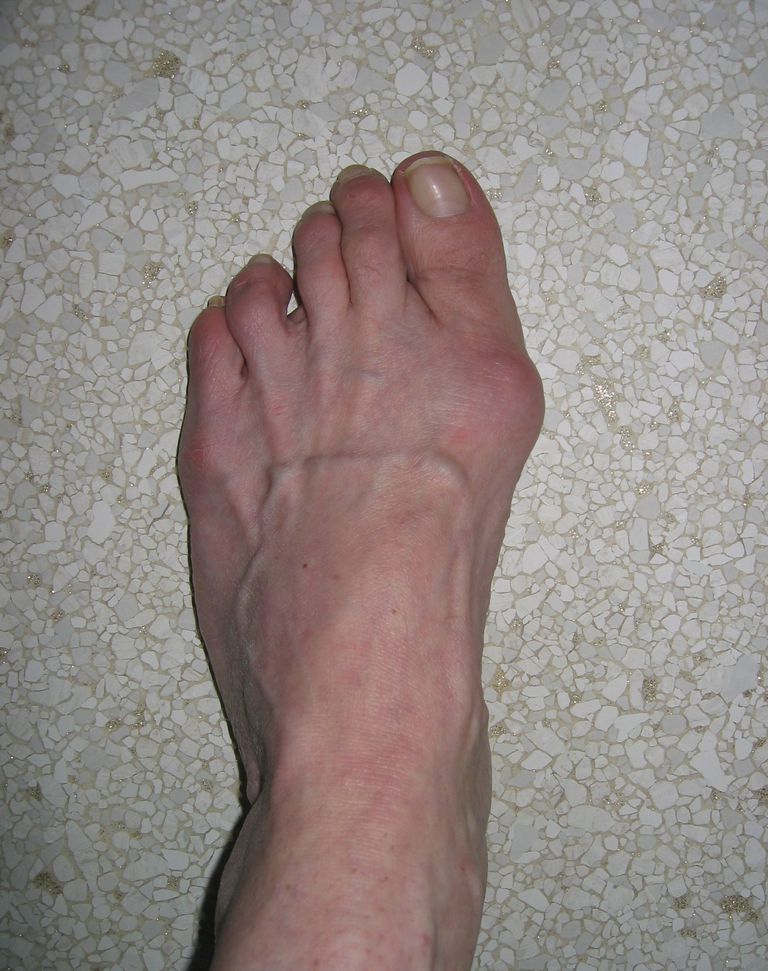 grote teen, ernst bunion, kunnen bijdragen, onder eerste, strakke schoenen, tweede teen
