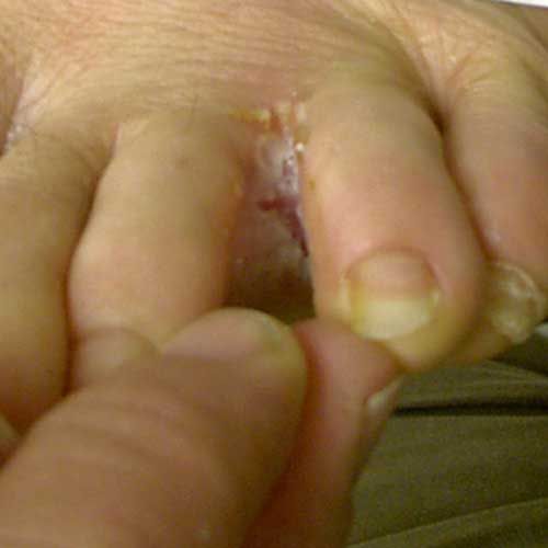 veroorzaakt door, tussen vingers, veel voorkomende, door herpes
