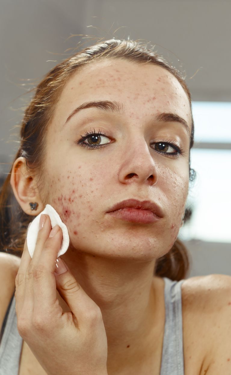 behandeling acne, blijven gebruiken, puistjes terug, voor behandeling, voor behandeling acne, dode huidcellen