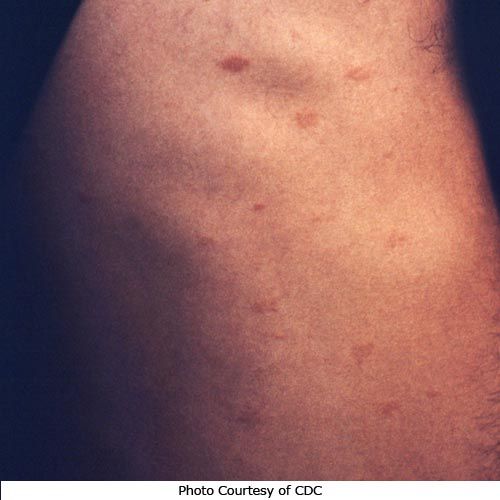 pityriasis rosea, kunnen zich, vanzelf oplost, armen benen, armen benen gezicht