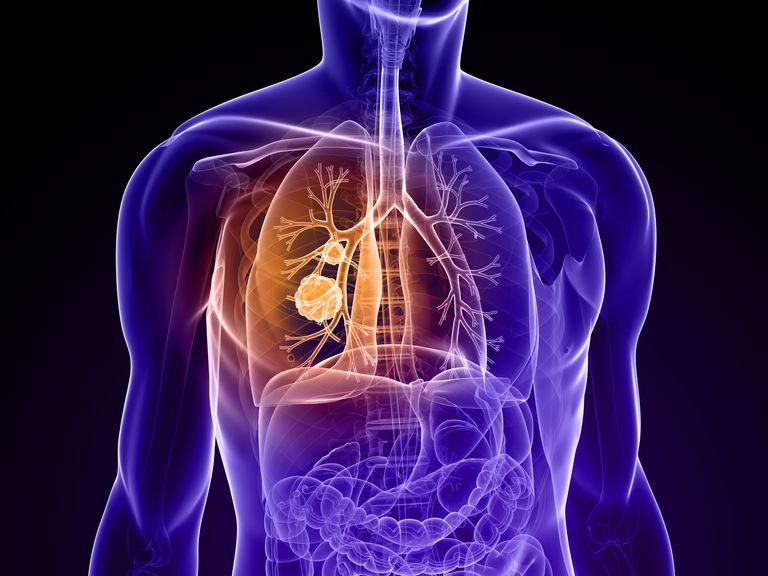 meest voorkomende, oorzaken longmassa, naar longen, worden aanbevolen
