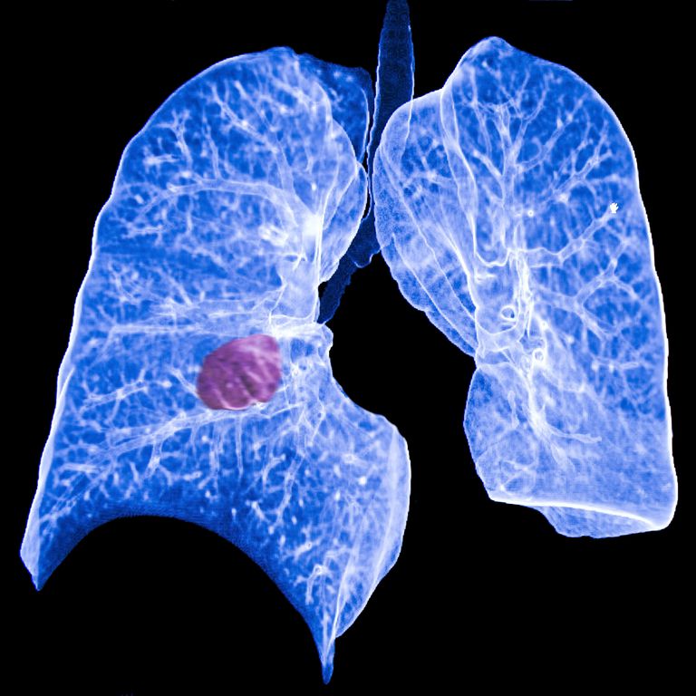 primaire longkanker, naar longen, geen verband, geen verband houden